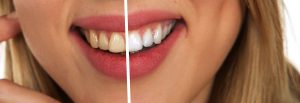 11 Best Teeth Whitening Apps for the Perfect Smile