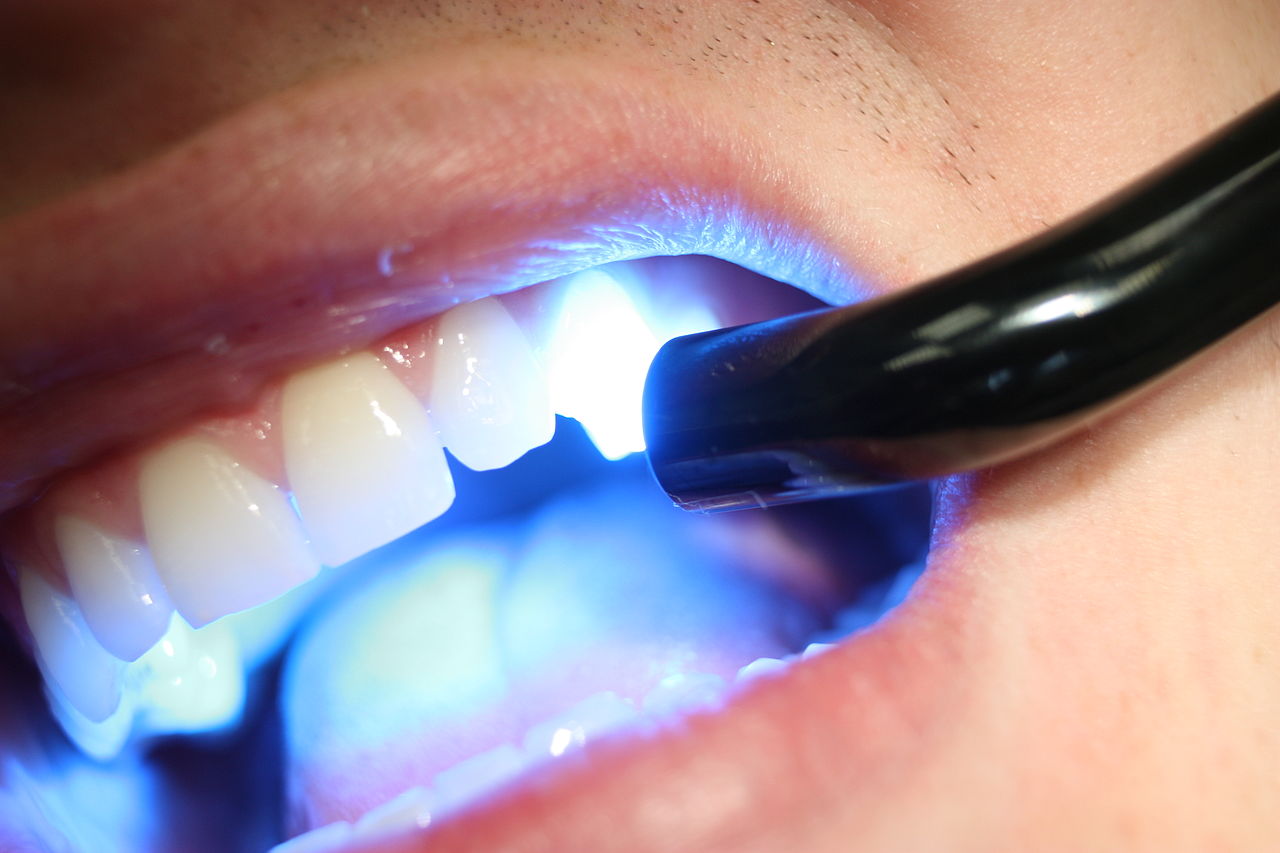 what-is-the-blue-light-that-dentist-use